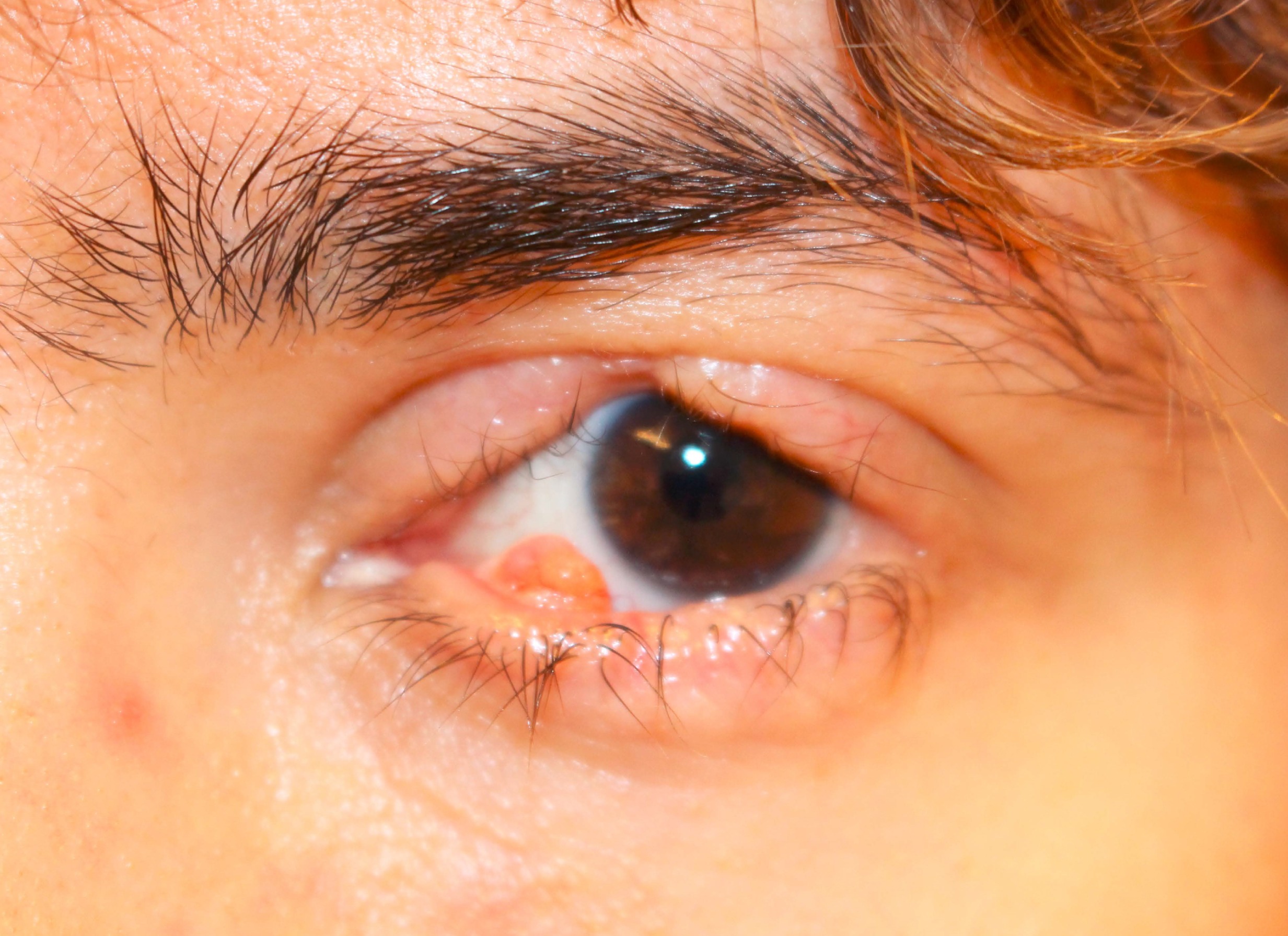 Ligneous Conjunctivitis